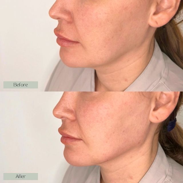 Dermal filler to the jaw to create more definition and most importantly to retract the jowls and any heaviness in the lower face. 🌿