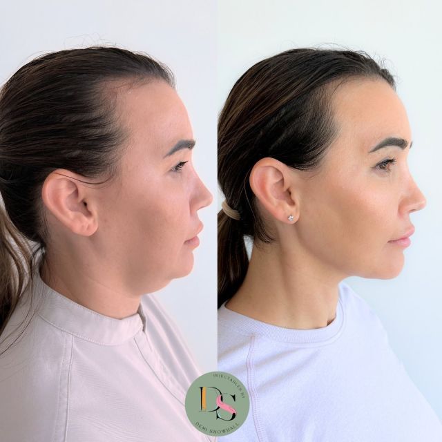 Our biggest transformation to date.
Treatment Lineup:
-Jaw
-Pre-Jowl Sulcus
-Pre-Auricular Region 
-Platysmal Bands (Neck Tightening) 
-Lips 
-Chin 
-Jaw Slimming 

Please note there has also been weight loss involved in the time between the before and after pictures. 
.
.
.
Disclaimer: A thorough medical consultation is undertaken prior to procedure to determine suitability. All procedures come with possible risks and side effects.