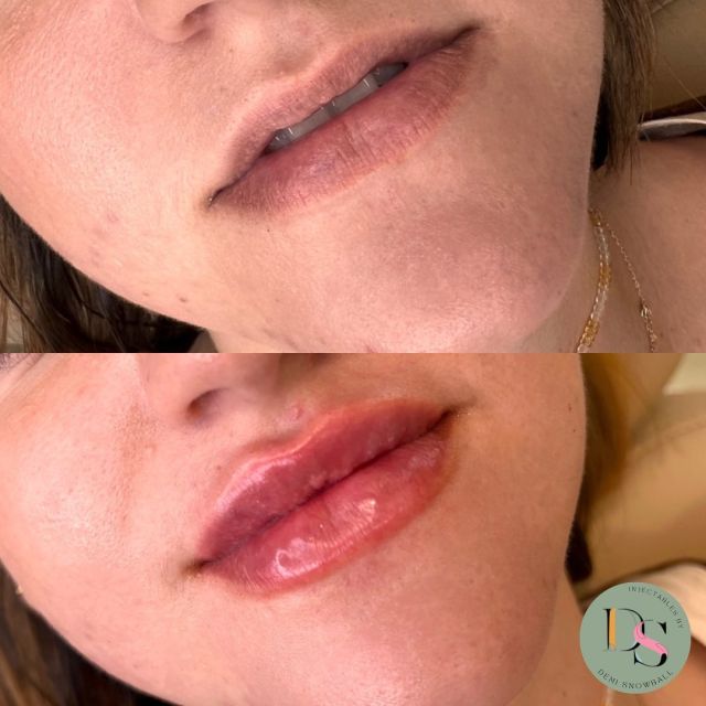 Dermal filler in all its glory. 🌿
