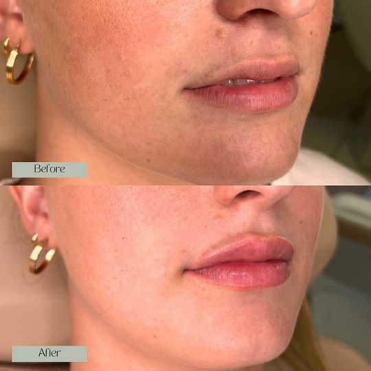 Dermal filler to the lip to maximise your pout potential. 🌿