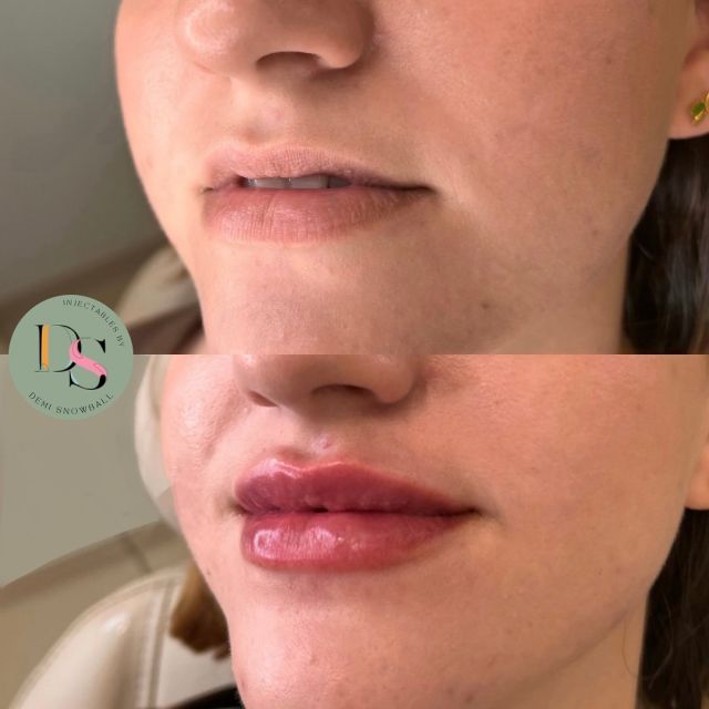 If you’re wanting to add symmetry and balance to your face, Dermal Filler in the lips is usually the best place to start. We always ensure a more natural result whilst still enhancing your smile. 🌿
