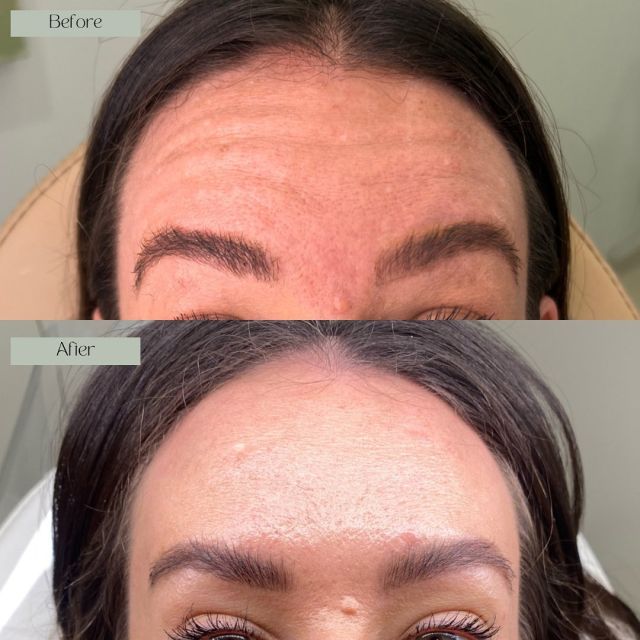 Frown and Forehead Anti-Wrinkle.🌿