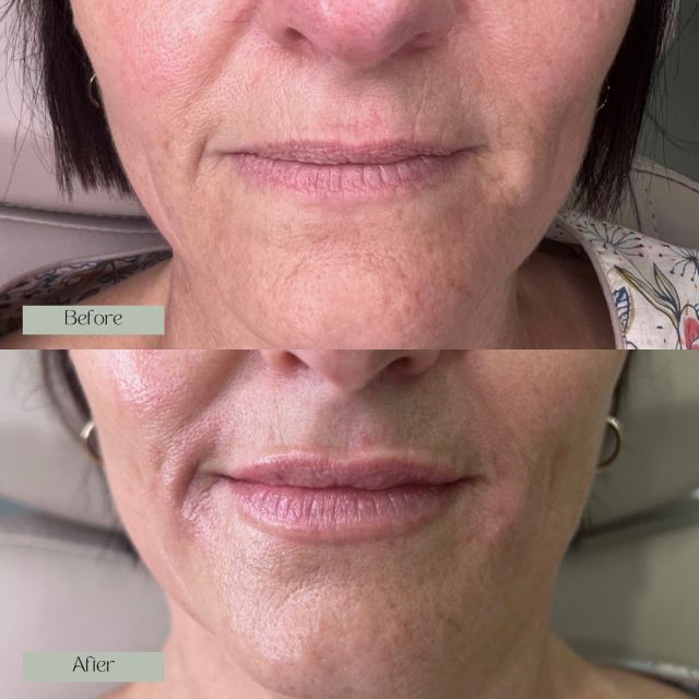 Dermal filler has been strategically placed to reduce the signs of ageing in the peri-oral region. 🌿