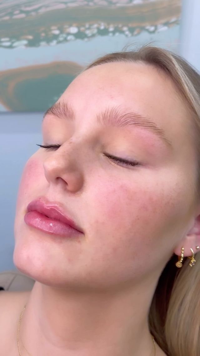 Dermal filler in the lips from start to finish. 💫